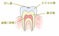 C0　初期の虫歯