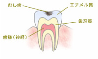 C1　エナメル質の虫歯