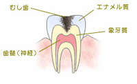C2　象牙質の虫歯