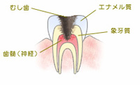 C3　神経の虫歯