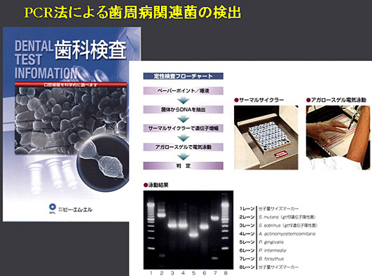 PCR法による歯周病関連菌の検出