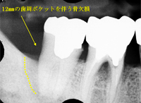 歯周組織再生