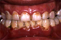 壊死性歯周疾患