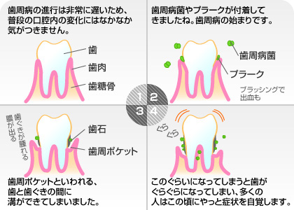 歯周病のホント